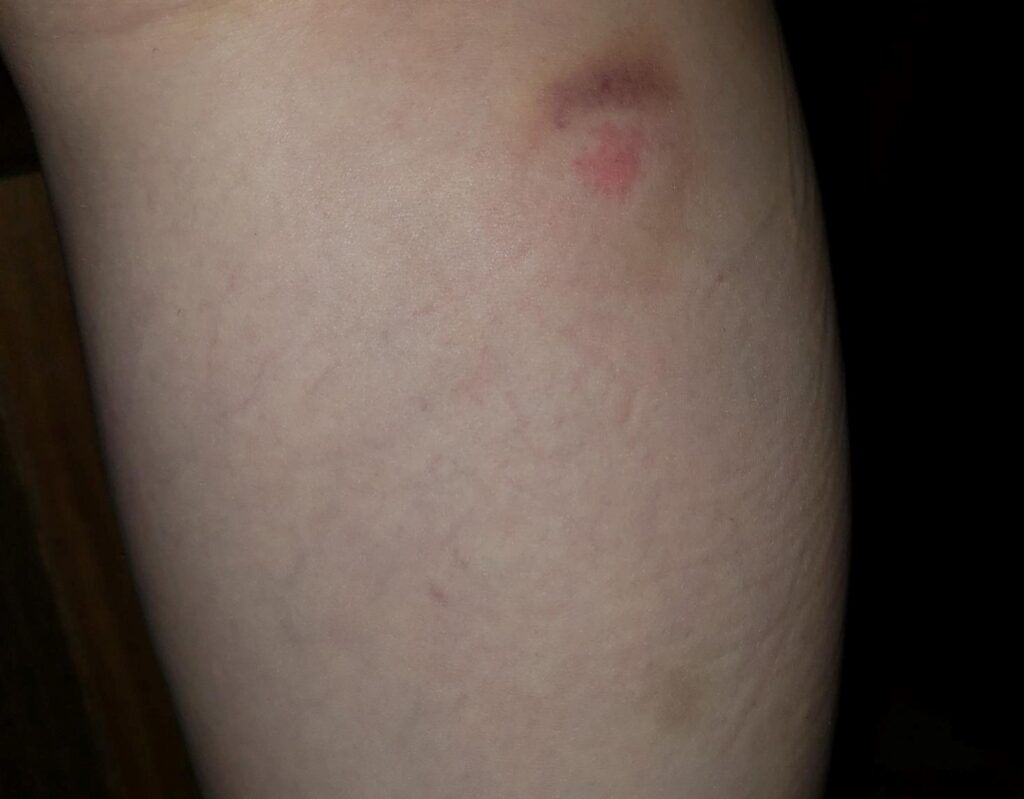 My Lyme rash back in 2019